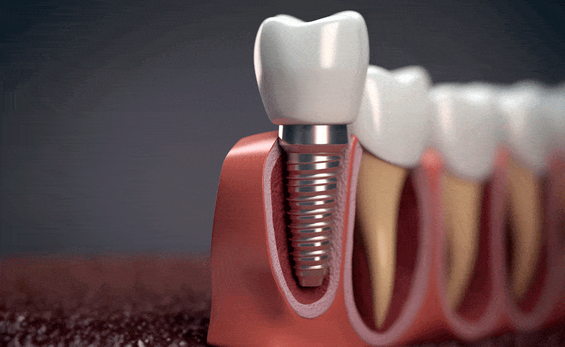 dental implants